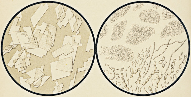 显微镜观察胆固醇晶体和钙/镁与发酵细菌从尿沉渣- 19世纪图片下载