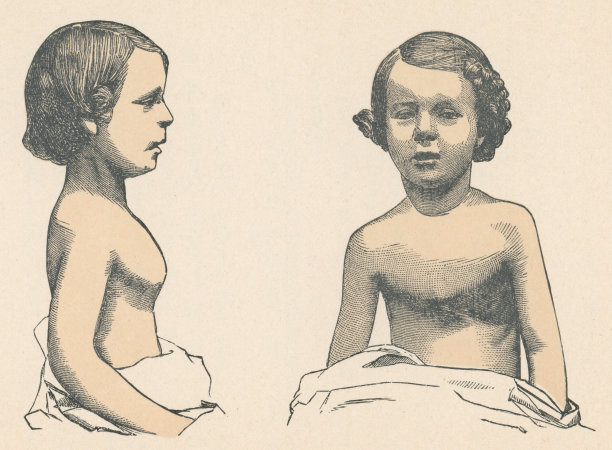 医学插图的一个男孩与胸隆- 19世纪图片下载