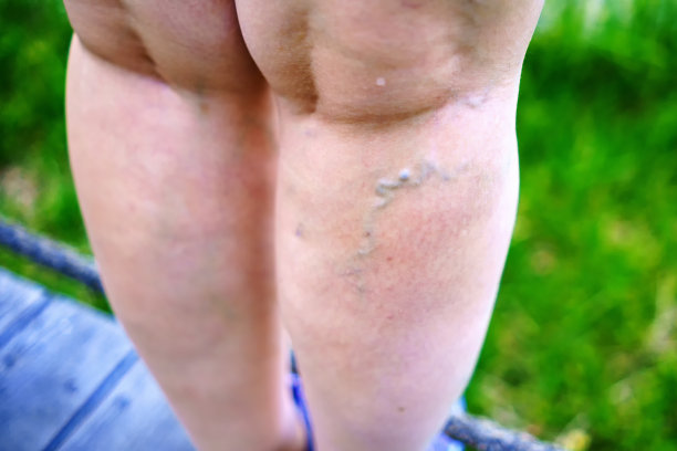 一个饱餐的女人腿上肿胀的静脉图片下载