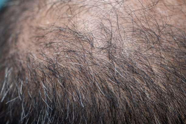 亚洲男性头部的秃点特写，有白头发和头皮屑问题。图片下载