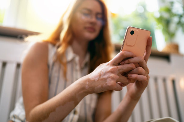 患白癜风的年轻女性用手机的近照图片下载