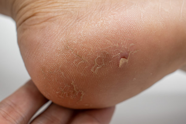 亚洲老妇人干裂的脚跟。图片下载