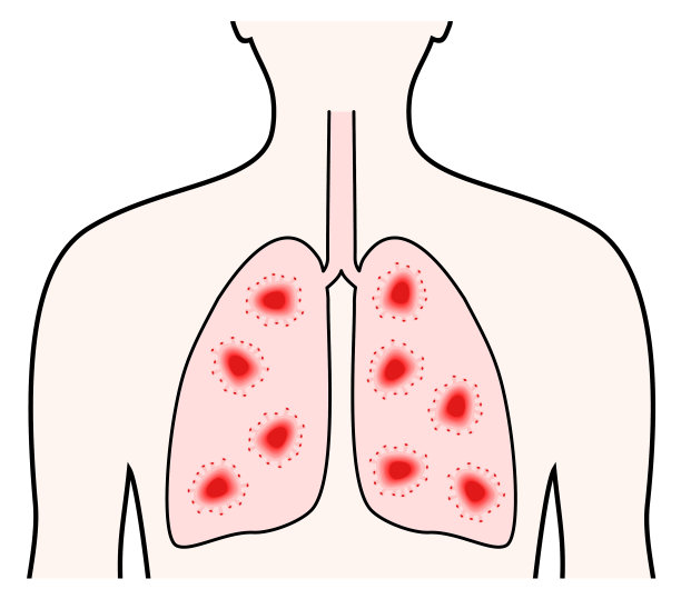 MERS CoV冠状病毒呼吸道感染。人类肺部概念图片下载
