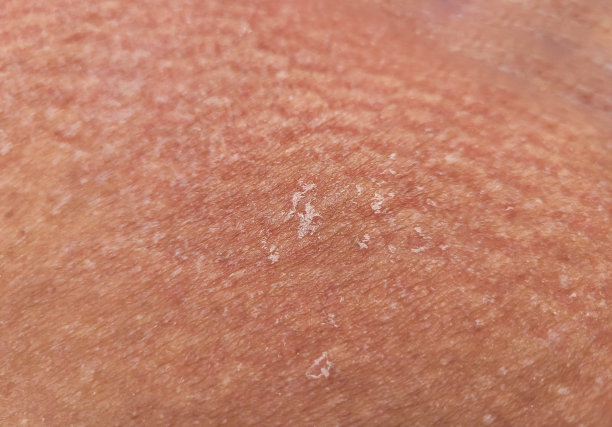 质地不健康的人体皮肤表皮与片状和碎裂的颗粒接近。图片下载