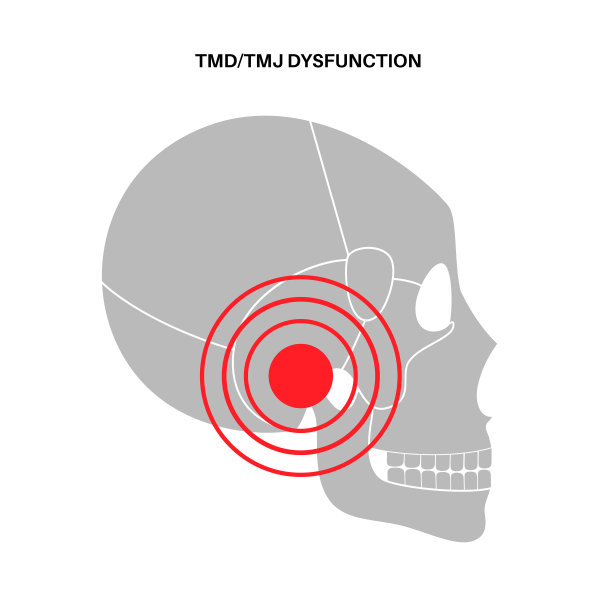 颞下颌关节紊乱图片下载