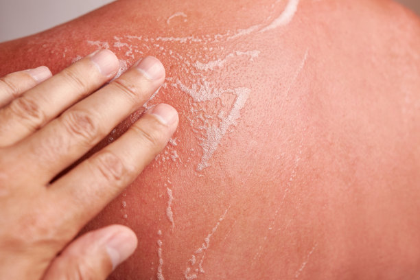 这种泡沫被涂在被太阳晒伤的皮肤上。皮肤晒伤。身体皮肤护理。防止过度晒伤和皮肤刺激。图片下载