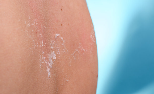 日晒后去角质图片下载