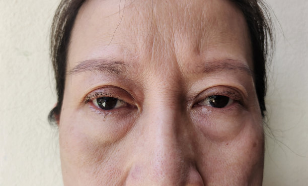 松弛、脂肪下垂、视力问题。图片下载