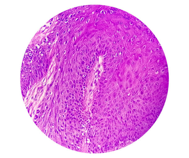 感染HPV病毒的皮肤细胞高倍放大图。常见的疣。寻常疣。微观的观点。图片下载