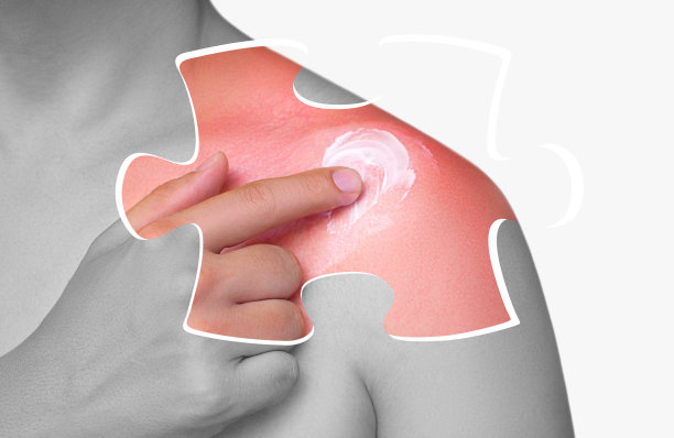 晒伤后皮肤发红发痒的人皮肤护理和保护免受太阳紫外线的伤害。美容的概念图片下载