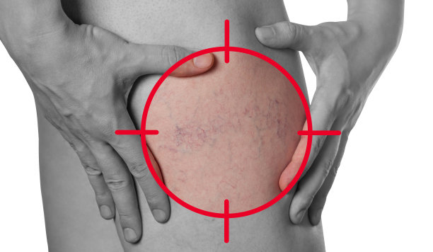 男子展示手座，腿部皮肤小血管扩张。毛细血管扩张的医学检查和治疗。图片下载