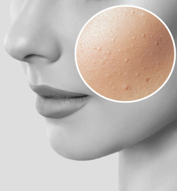 一个皮肤有问题的年轻女孩。痤疮治疗前后的照片。图片下载