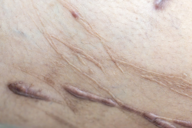 疤痕是在受伤后取代正常皮肤的纤维组织区域。图片下载