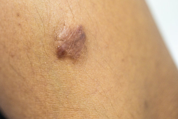 疤痕是在受伤后取代正常皮肤的纤维组织区域。图片下载