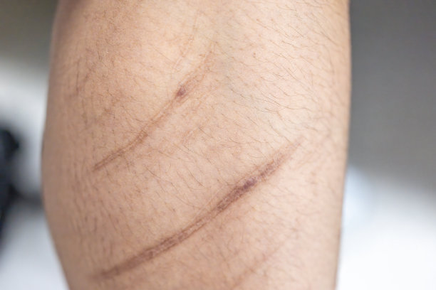 疤痕是在受伤后取代正常皮肤的纤维组织区域。图片下载