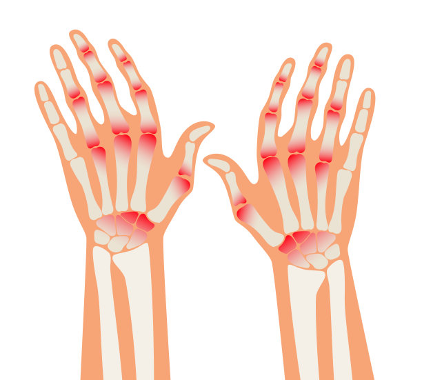 类风湿性关节炎。人体内的疼痛。关节炎，骨病的医学海报。手指关节炎矢量图图片下载
