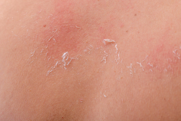 在没有涂防晒霜的情况下晒伤图片下载