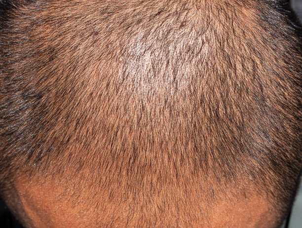 脱发的中年男子图片下载