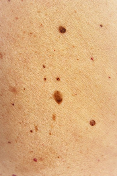 人类皮肤上的痣和胎记图片下载