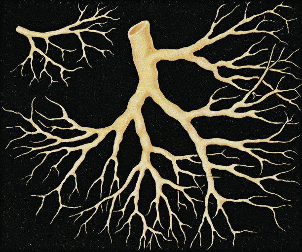 白喉病人细支气管树纤维性血块的显微镜观察- 19世纪图片下载