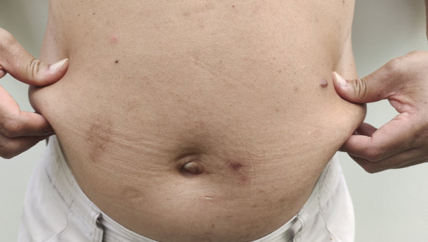 肥胖导致皮肤松弛，腹部脂肪团过重，腰部肥胖导致皮肤松弛。图片下载