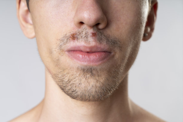 一个年轻男子与疱疹病毒感冒-口腔感染-他的嘴唇和嘴角唇炎的特写图片下载