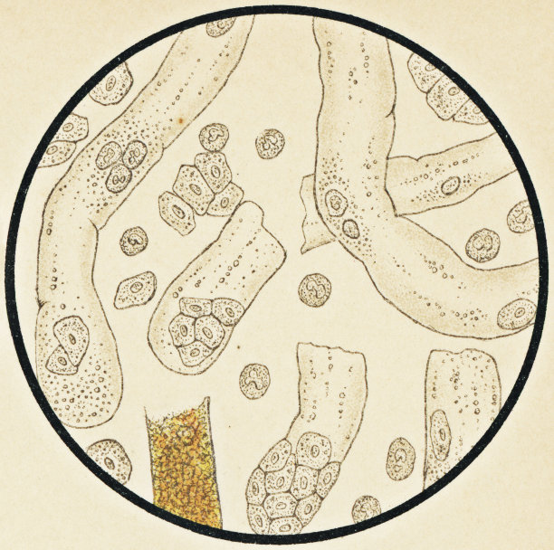 慢性肾病患者尿液沉积物的显微镜观察- 19世纪图片下载