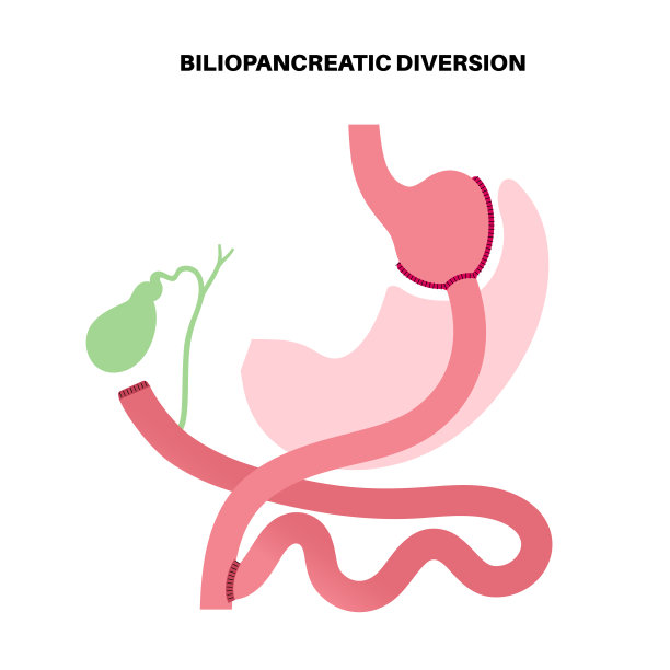 胆胰分流手术图片下载