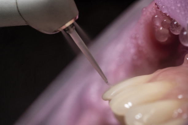 激光蚀刻牙齿手术特写图片下载