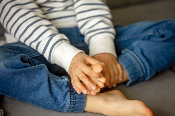 儿童出现皮疹、红疹。手足口病。肠病毒腿手臂口儿童有皮疹。Cocksackie病毒图片下载