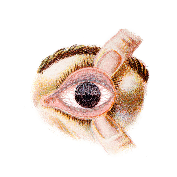 沙眼是由沙眼衣原体细菌引起的一种传染病。感染会导致眼睑内表面粗糙图片下载