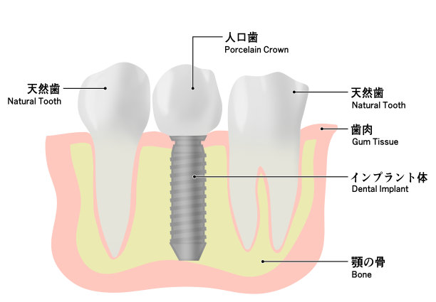 种植牙和天然牙的简单图示图片下载