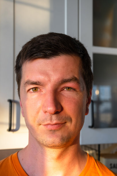 特写镜头中，男人脸上红肿的眼睑是对昆虫叮咬过敏。对吸血昆虫过敏图片下载