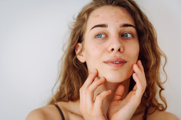 一个美丽的年轻女子的肖像，脸上有炎症。医学和美容。图片下载