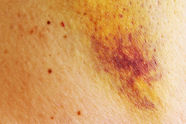 皮肤瘀伤图片下载