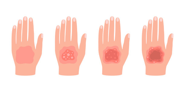 手部人体皮肤不同程度烧伤。急救火灾或化学伤害皮肤。视觉症状烧伤。向量图片下载
