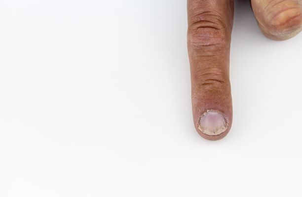 白色背景下患银屑病的手指特写图片下载