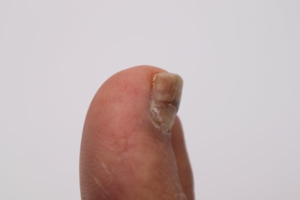 受伤指甲特写图片下载