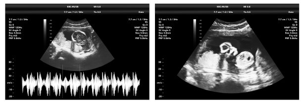 妊娠超声膜遗传生态学超声图，婴儿医学超扫描诊断控制图片下载