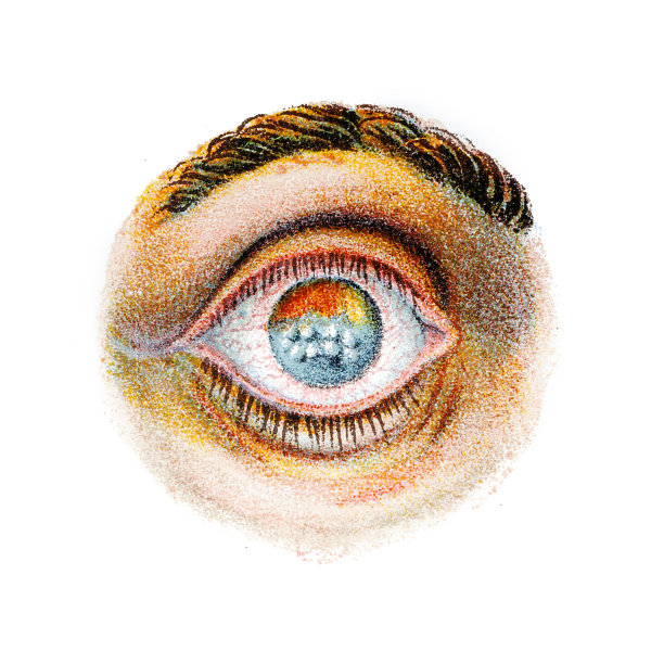 眼部疾病眼部炎症，角膜实质炎症图片下载