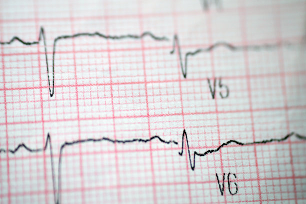 心电图，描绘心脏的电流，提供关于心脏状况和节律的信息，排除心绞痛或心肌梗塞，正常心电图图片下载