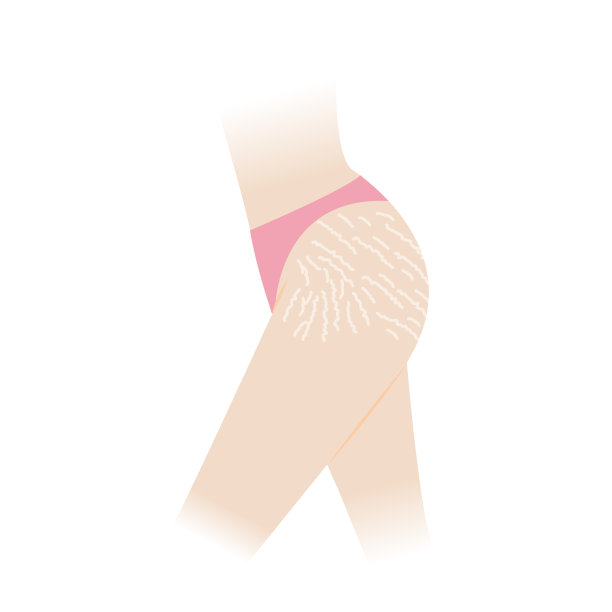 妊娠纹在臀部和大腿矢量插图隔离在白色背景。图片下载