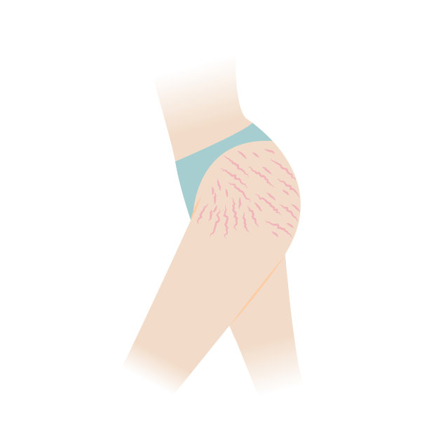 红色妊娠纹在臀部和大腿矢量插图隔离在白色背景。图片下载