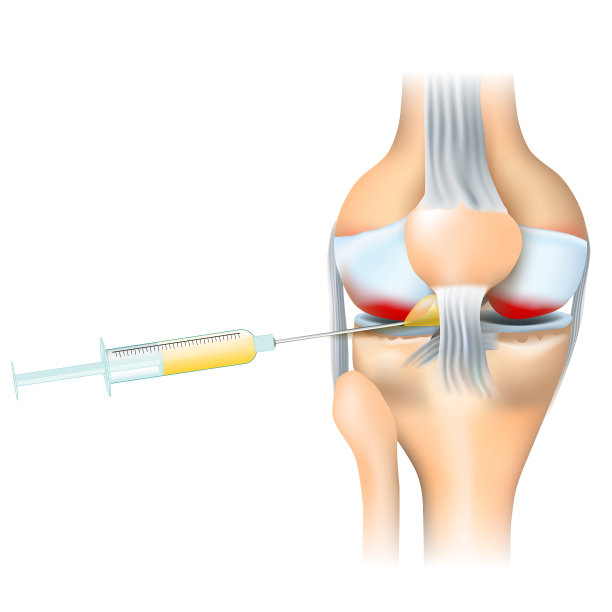 骨关节炎的治疗图片下载