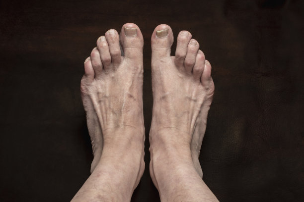 甲真菌感染图片下载