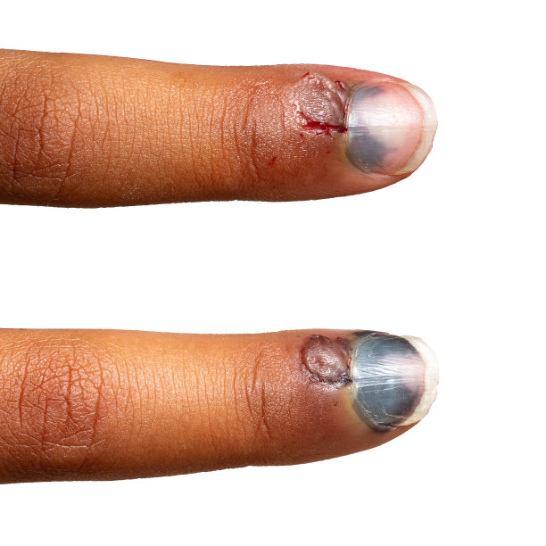 手指压伤血肿的演变图片下载