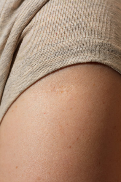 米色上分离出天花疫苗疤痕的妇女特写图片下载