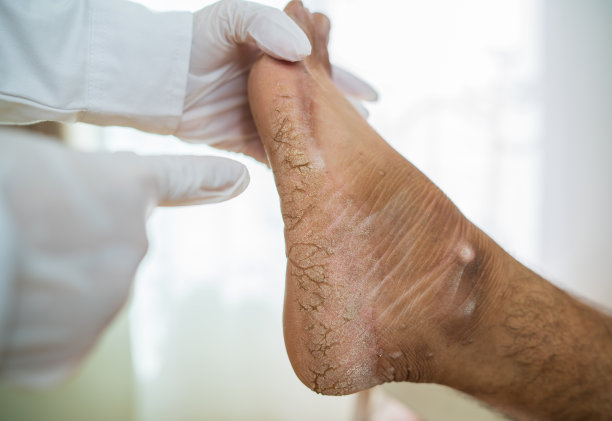 非常重的人的破裂脚后跟特写：有裂缝开口，非常严重，感染和干燥，选择性聚焦图片下载