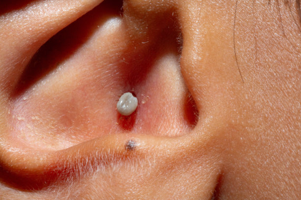 意大利罗维戈——2023年8月12日:一个被蜱虫寄生的儿童耳朵的微距照片。在人耳廓内吸血的寄生虫。图片下载