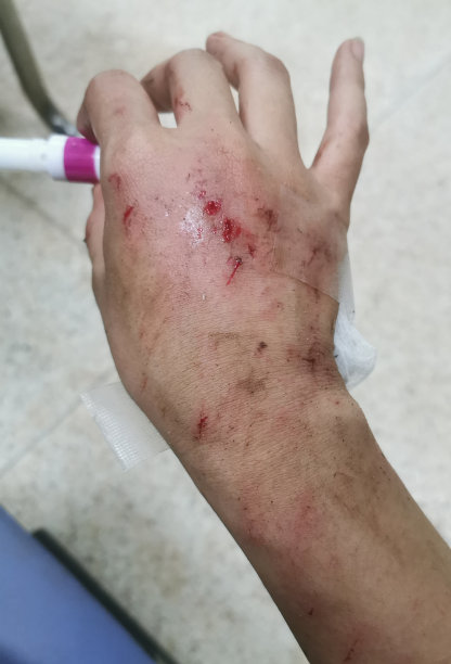 手背上有伤口图片下载
